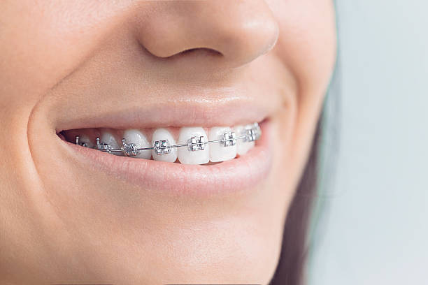 Best Veneers and Lumineers  in USA